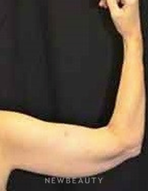 Dr. Aviva Preminger - Arm Lift - After