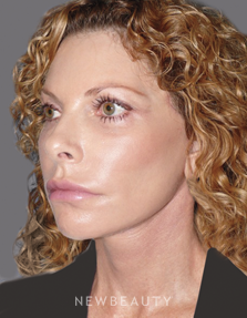 Dr. Andrew Ordon Facelift, Necklift, Chemical Peel, Injectables & Fillers, Lasers - After