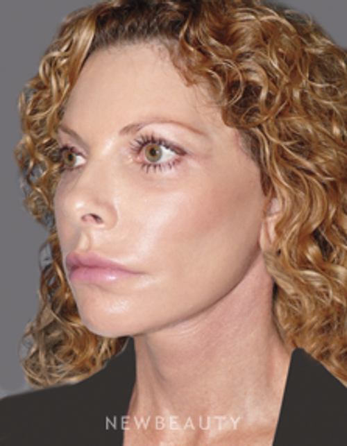 Dr. Andrew Ordon Facelift, Necklift, Chemical Peel, Injectables & Fillers, Lasers - After