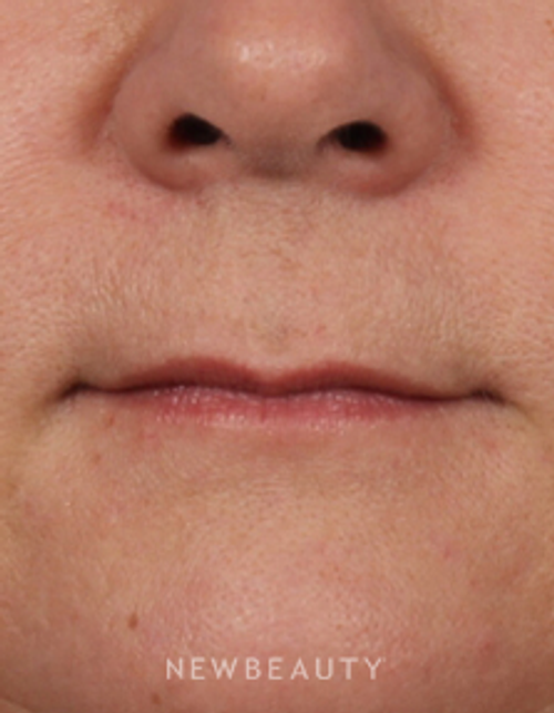 Dr. Kelly Bomer - Volumizing Difference - Before