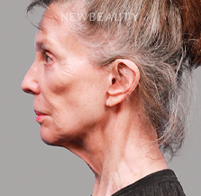 Dr. Michael Zwicklbauer - Youthful Restoration - 44689427 - Before