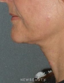 Dr. Min Ahn - Necklift - After
