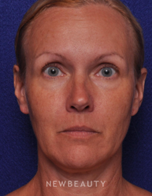 Dr. Alan Durkin - Blepharoplasties - After