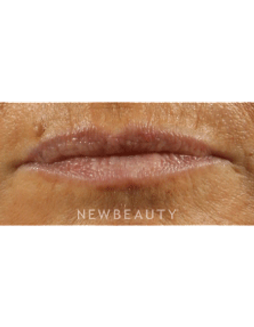 Dr. Marina Peredo Lip Augmentation - Before