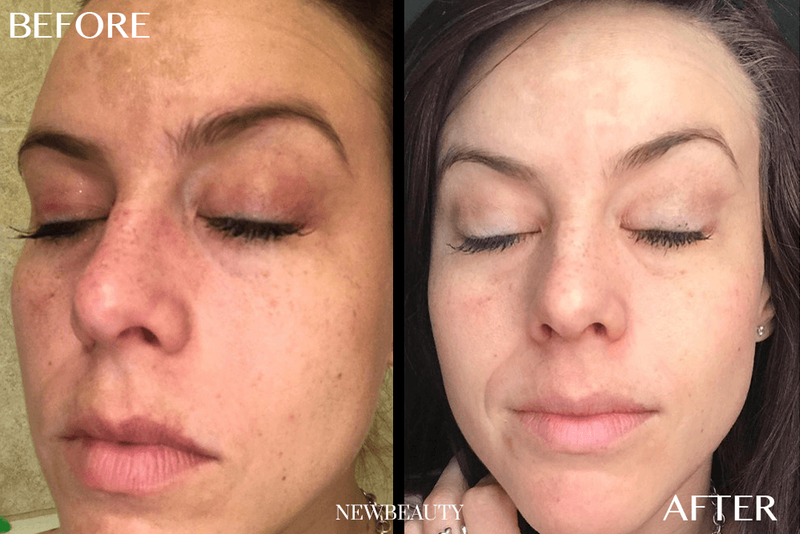 hyperpigmentationba 1