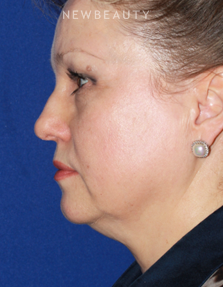 Dr. Konstantin Vasyukevich - Facelift - Before