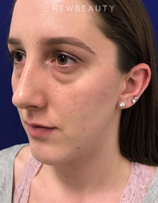 Dr. Dilip Madnani - Lower Blepharoplasty - Before