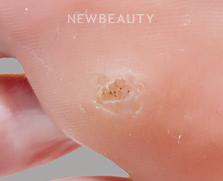 Dr. Anna Chacon - Warts - 34278788 - After