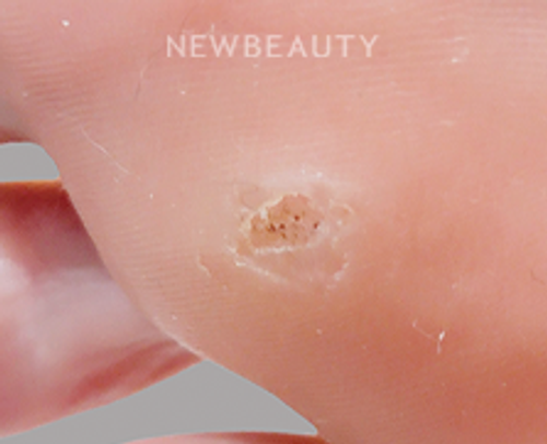 Dr. Anna Chacon - Warts - 34278788 - After