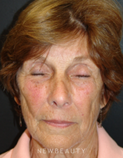 Dr. Mokhtar Asaadi Eyelid Lift, Facelift, Necklift - Before
