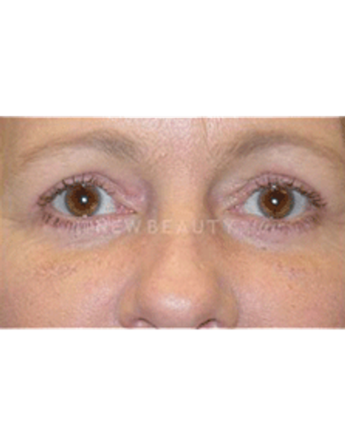 Dr. Phillip Chang Eyelift - After