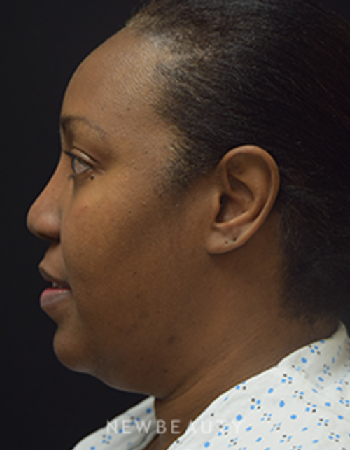 Dr. Jeffrey B. Wise - Lipo & Rhinoplasty - Before