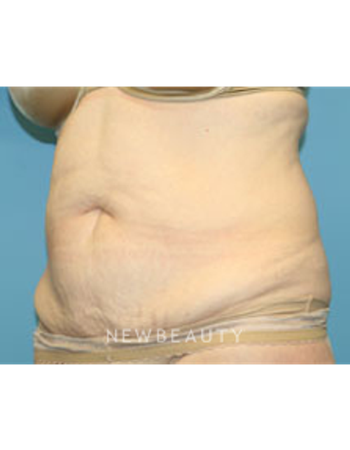 Dr. Christine Hamori - Tummy Tuck - Before