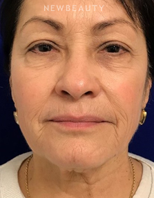 Dr. Dilip Madnani - Facelift - 13691970 - Before