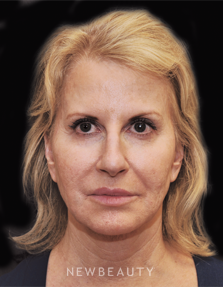 Dr. Janet Allenby Injectables & Fillers - After