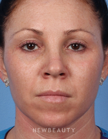 Dr. Kelly Bomer – Chemical Peels, Microneedling - After