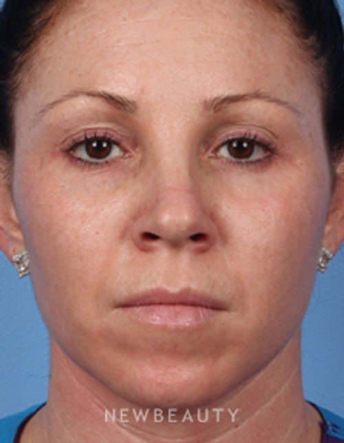 Dr. Kelly Bomer – Chemical Peels, Microneedling - After