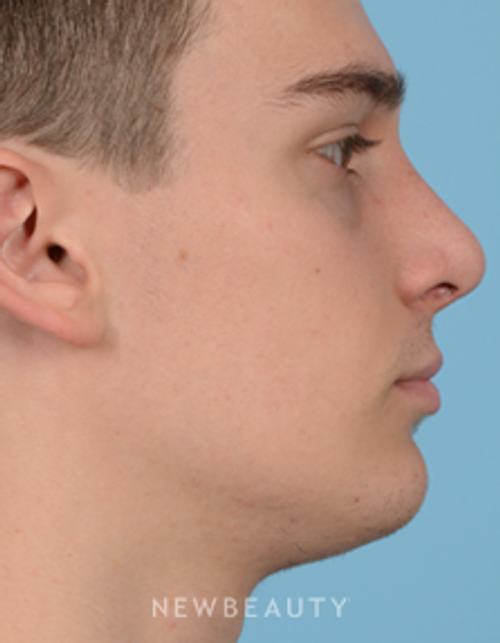 Dr. Jeffrey Wise - Rhinoplasty - After