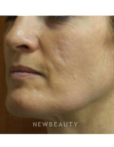 Dr. Jody Levine - Acne Scars - Before