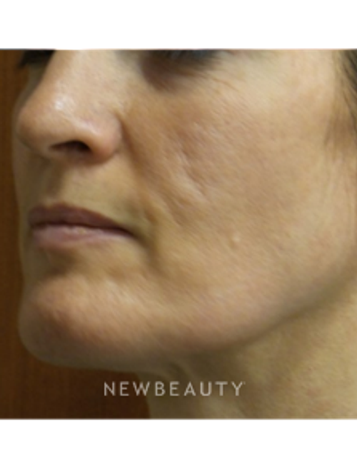 Dr. Jody Levine - Acne Scars - Before