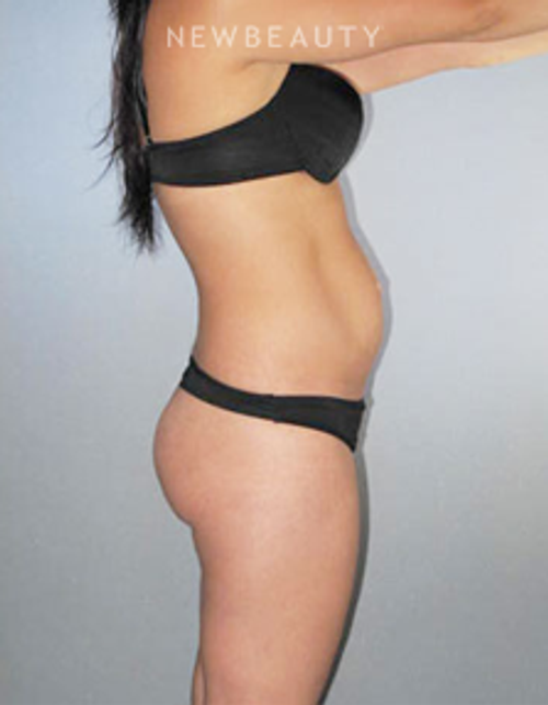 Dr. German Newall - Tighter Midsection - Before