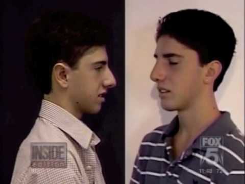 Dr. Jacono – Teen Rhinoplasty