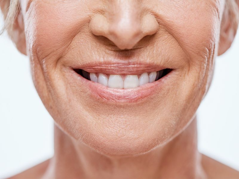 Turkey Teeth: The Beauty Trend You Should Avoid