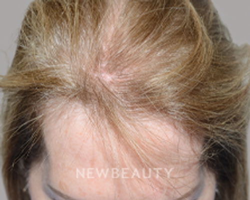 Dr. Jeffrey Epstein - Revived Tresses - 44714605 - Before