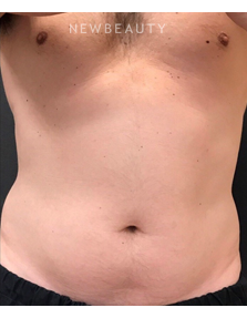 Dr. Janet Allenby - CoolSculpting - Before