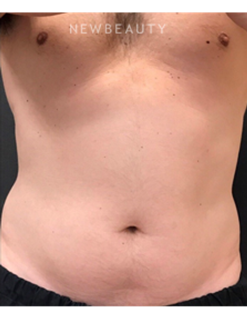 Dr. Janet Allenby - CoolSculpting - Before