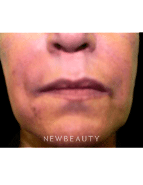 Dr. Marina Peredo Radiesse - After
