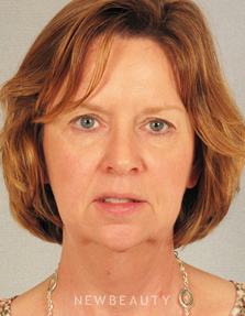 Dr. Henry Mentz Eyelift, Facelift, Necklift - Before