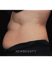 Dr. Janet Allenby, Fat Melters - Before