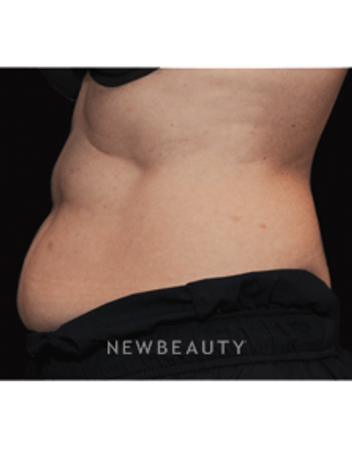 Dr. Janet Allenby, Fat Melters - Before