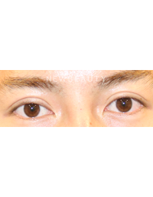 Dr. Lily Lee - Upper Blepharoplasty - After