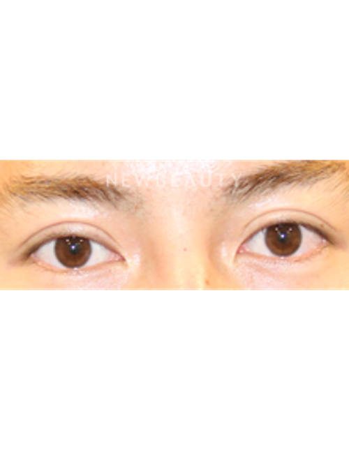 Dr. Lily Lee - Upper Blepharoplasty - After
