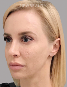 Dr. Janet Allenby - Microneedling with Radio Frequency - 24249321 - Before