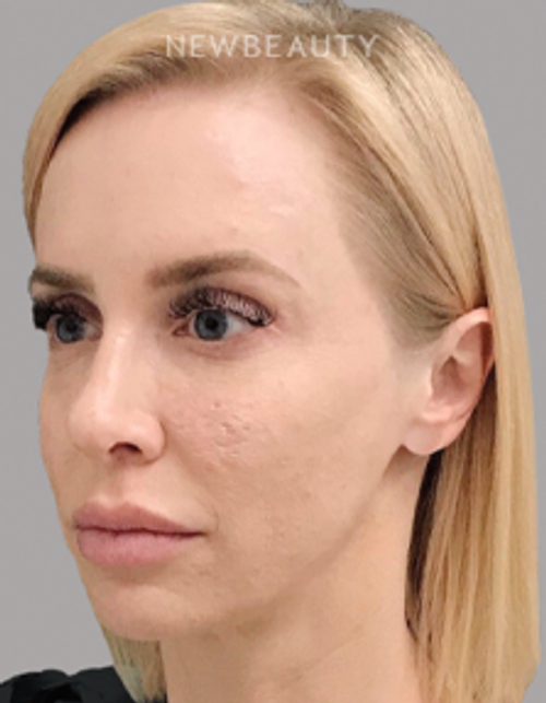 Dr. Janet Allenby - Microneedling with Radio Frequency - 24249321 - Before