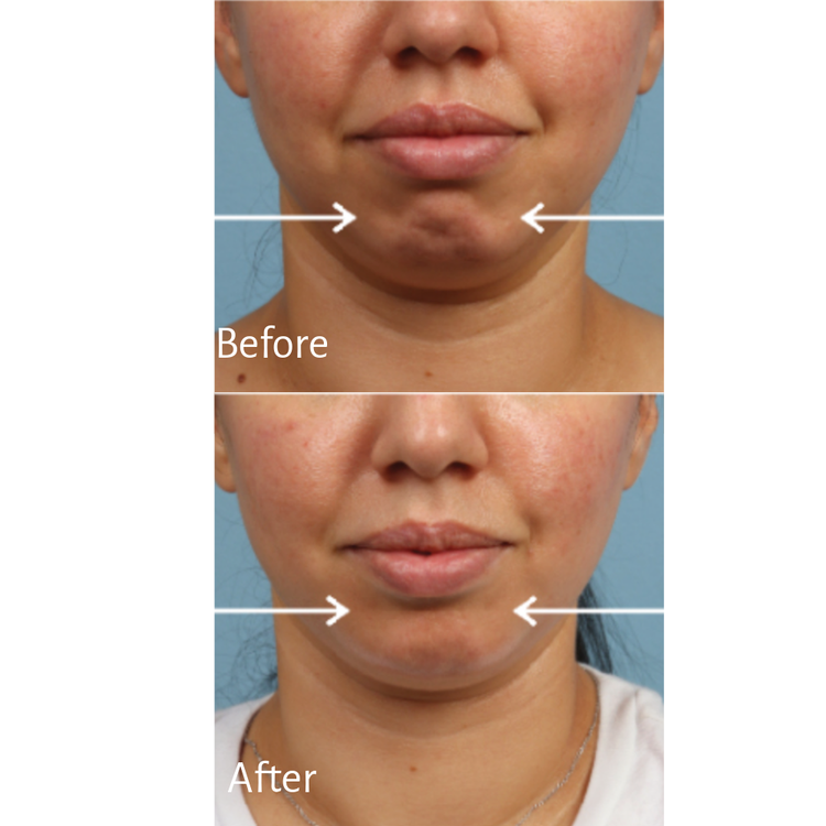 Dimple Fill-In