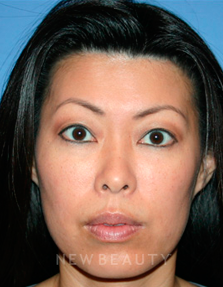 Dr. Kelly Bomer Injectables - After