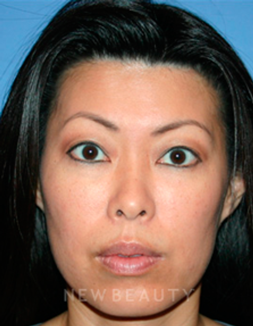 Dr. Kelly Bomer Injectables - After