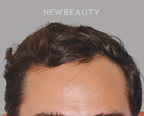 Dr. Anthony Bared - Hair Transplant - 46164621 - After