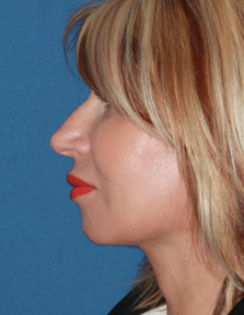 Dr. Konstantin Vasyukevich, Traditional Facelift - After