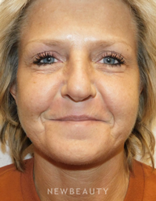 Dr. Joel Schlessinger - Injectables & Fillers - After