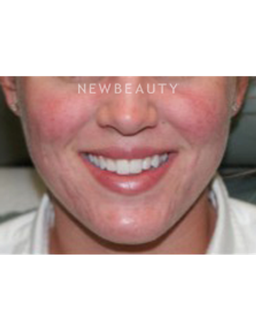 Dr. Marina Peredo - Acutane - After