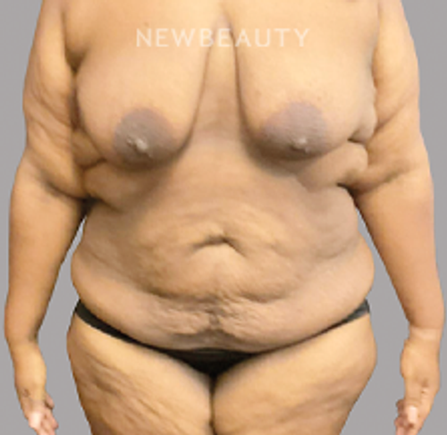 Dr. Ralph Garramone - Mommy Makeover - 44409267 - Before