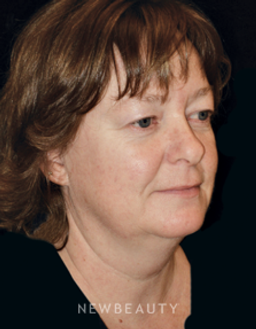 Dr. Phillip Chang - Mini-Facelift - Before