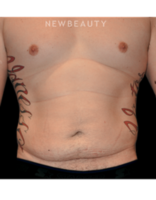 Dr. Bryan W. Gawley - A Tighter Midsection - Before