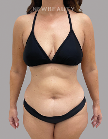 Dr. Daniel Crane – Mommy Makeover - 46166444 - Before