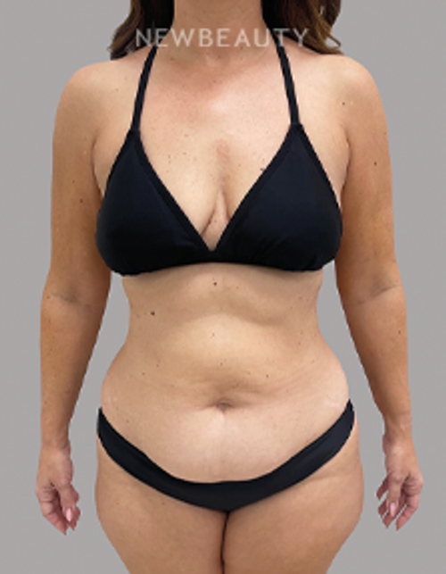 Dr. Daniel Crane – Mommy Makeover - 46166444 - Before